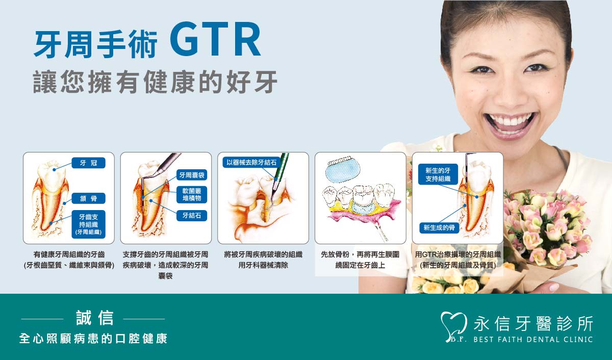 牙周手術 GTR，讓您擁有健康的好牙